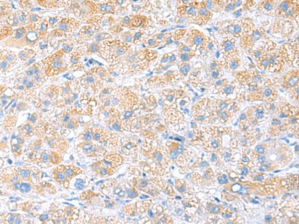 RPS16 / Ribosomal Protein S16 Antibody - Immunohistochemistry of paraffin-embedded Human liver cancer tissue  using RPS16 Polyclonal Antibody at dilution of 1:65(×200)