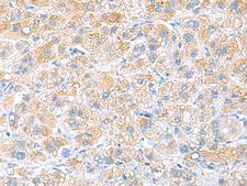 RPS16 / Ribosomal Protein S16 Antibody - Immunohistochemistry of paraffin-embedded Human liver cancer tissue  using RPS16 Polyclonal Antibody at dilution of 1:65(×200)