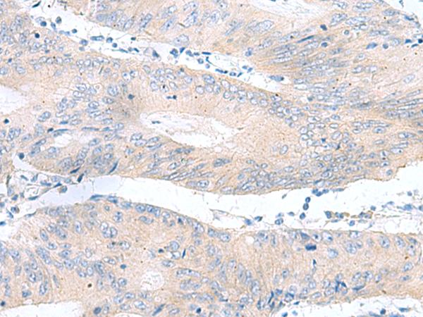 RPS16 / Ribosomal Protein S16 Antibody - Immunohistochemistry of paraffin-embedded Human colorectal cancer tissue  using RPS16 Polyclonal Antibody at dilution of 1:65(×200)