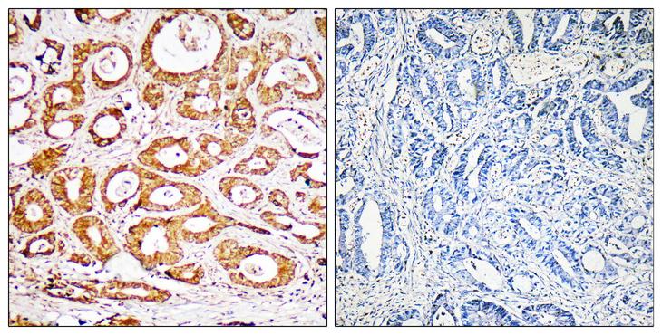 RPS19 / Ribosomal Protein S19 Antibody - Peptide - + Immunohistochemistry analysis of paraffin-embedded human colon carcinoma tissue, using RPS19 antibody.