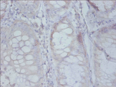 RPS19BP1 Antibody - Immunohistochemistry of paraffin-embedded human colon cancer using RPS19 Antibody at dilution of 1: 50