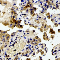 RPS20 / Ribosomal Protein S20 Antibody - Immunohistochemical analysis of RPS20 staining in human lung cancer formalin fixed paraffin embedded tissue section. The section was pre-treated using heat mediated antigen retrieval with sodium citrate buffer (pH 6.0). The section was then incubated with the antibody at room temperature and detected using an HRP polymer system. DAB was used as the chromogen. The section was then counterstained with hematoxylin and mounted with DPX.