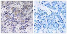 RPS21 / Ribosomal Protein S21 Antibody - Immunohistochemistry analysis of paraffin-embedded human breast carcinoma tissue, using RPS21 Antibody. The picture on the right is blocked with the synthesized peptide.