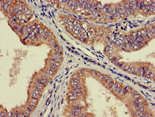 RPS21 / Ribosomal Protein S21 Antibody - Immunohistochemistry image of paraffin-embedded human endometrial cancer at a dilution of 1:100