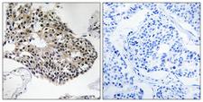 RPS25 / Ribosomal Protein S25 Antibody - Immunohistochemistry analysis of paraffin-embedded human breast carcinoma tissue, using RPS25 Antibody. The picture on the right is blocked with the synthesized peptide.