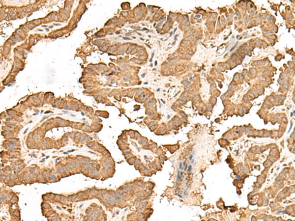RPS25 / Ribosomal Protein S25 Antibody - Immunohistochemistry of paraffin-embedded Human thyroid cancer tissue  using RPS25 Polyclonal Antibody at dilution of 1:65(×200)