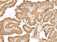 RPS25 / Ribosomal Protein S25 Antibody - Immunohistochemistry of paraffin-embedded Human thyroid cancer tissue  using RPS25 Polyclonal Antibody at dilution of 1:65(×200)