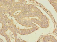 RPS27 / Ribosomal Protein S27 Antibody - Immunohistochemistry of paraffin-embedded human endometrial cancer at dilution 1:100