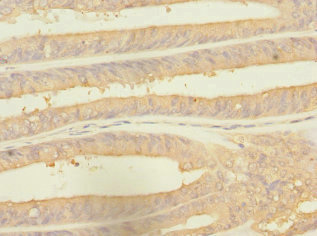 RPS27 / Ribosomal Protein S27 Antibody - Immunohistochemistry of paraffin-embedded human endometrial cancer at dilution 1:100