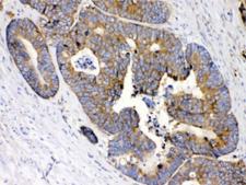 RPS27 / Ribosomal Protein S27 Antibody - IHC testing of FFPE human intestine cancer tissue with MPS1 antibody at 1ug/ml. HIER: steam section in pH6 citrate buffer for 20 min.