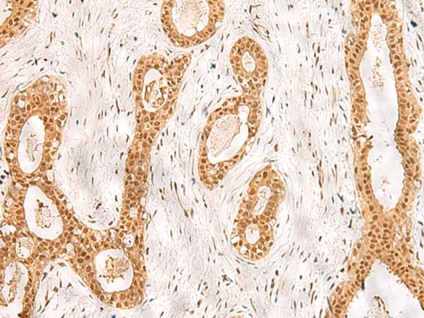 RPS27A Antibody - Immunohistochemistry of paraffin-embedded Human breast cancer tissue  using RPS27A Polyclonal Antibody at dilution of 1:40(×200)