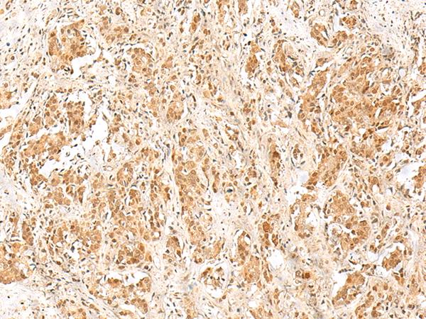 RPS27A Antibody - Immunohistochemistry of paraffin-embedded Human prost ate cancer tissue  using RPS27A Polyclonal Antibody at dilution of 1:40(×200)