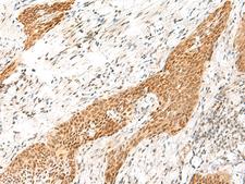 RPS27A Antibody - Immunohistochemistry of paraffin-embedded Human esophagus cancer tissue  using RPS27A Polyclonal Antibody at dilution of 1:35(×200)