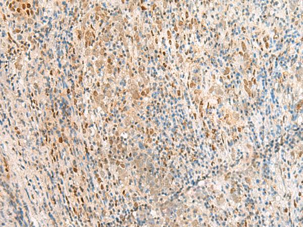 RPS27A Antibody - Immunohistochemistry of paraffin-embedded Human cervical cancer tissue  using RPS27A Polyclonal Antibody at dilution of 1:35(×200)