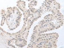 RPS27L Antibody - Immunohistochemistry of paraffin-embedded Human thyroid cancer tissue  using RPS27L Polyclonal Antibody at dilution of 1:55(×200)
