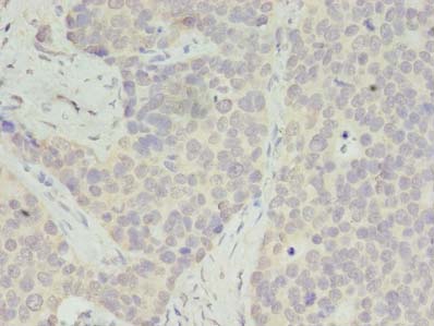RPS28 / Ribosomal Protein S28 Antibody - Immunohistochemistry of paraffin-embedded human gastric cancer using antibody at dilution of 1:100.