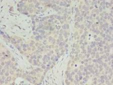 RPS28 / Ribosomal Protein S28 Antibody - Immunohistochemistry of paraffin-embedded human gastric cancer using antibody at dilution of 1:100.