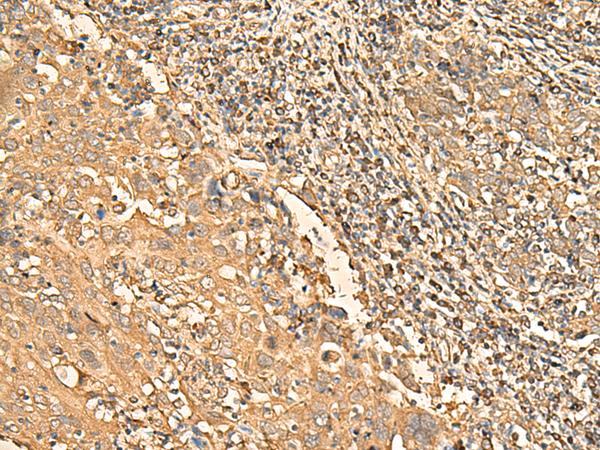 RPS28 / Ribosomal Protein S28 Antibody - Immunohistochemistry of paraffin-embedded Human cervical cancer tissue  using RPS28 Polyclonal Antibody at dilution of 1:30(×200)