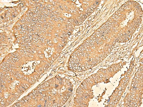 RPS28 / Ribosomal Protein S28 Antibody - Immunohistochemistry of paraffin-embedded Human colorectal cancer tissue  using RPS28 Polyclonal Antibody at dilution of 1:30(×200)