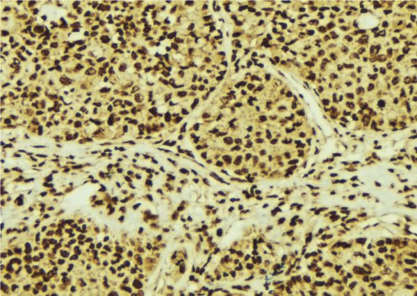 RPS3 / Ribosomal Protein S3 Antibody - 1:100 staining human breast carcinoma tissue by IHC-P. The sample was formaldehyde fixed and a heat mediated antigen retrieval step in citrate buffer was performed. The sample was then blocked and incubated with the antibody for 1.5 hours at 22°C. An HRP conjugated goat anti-rabbit antibody was used as the secondary.