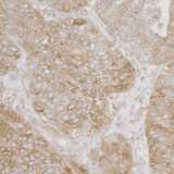 RPS3A / Ribosomal Protein S3A Antibody - Detection of human Ribosomal Protein S3A by immunohistochemistry. Sample: FFPE section of human ovarian carcinoma. Antibody: Affinity purified rabbit anti-Ribosomal Protein S3A used at a dilution of 1:1,000 (1µg/ml). Detection: DAB