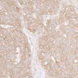 RPS3A / Ribosomal Protein S3A Antibody - Detection of human Ribosomal Protein S3A by immunohistochemistry. Sample: FFPE section of human ovarian carcinoma. Antibody: Affinity purified rabbit anti-Ribosomal Protein S3A used at a dilution of 1:5,000 (0.2µg/ml). Detection: DAB