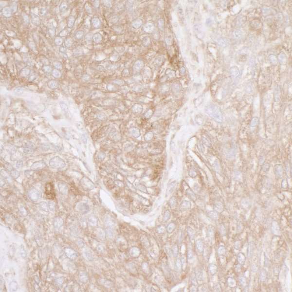 RPS3A / Ribosomal Protein S3A Antibody - Detection of human Ribosomal Protein S3A by immunohistochemistry. Sample: FFPE section of human ovarian carcinoma. Antibody: Affinity purified rabbit anti-Ribosomal Protein S3A used at a dilution of 1:5,000 (0.2µg/ml). Detection: DAB