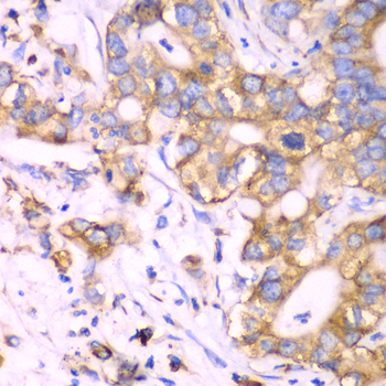 RPS3A / Ribosomal Protein S3A Antibody - Immunohistochemistry of paraffin-embedded human liver cancer tissue.