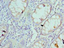 RPS4X + RPS4Y1 + RPS Antibody - Immunohistochemistry of paraffin-embedded human colon cancer using antibody at 1:100 dilution.