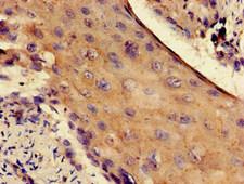 RPS4X + RPS4Y1 + RPS Antibody - Immunohistochemistry of paraffin-embedded human cervical cancer at dilution of 1:100