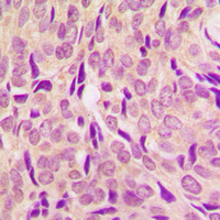 RPS6 / Ribosomal Protein S6 Antibody - Immunohistochemical analysis of RPS6 (pS240) staining in human breast cancer formalin fixed paraffin embedded tissue section. The section was pre-treated using heat mediated antigen retrieval with sodium citrate buffer (pH 6.0). The section was then incubated with the antibody at room temperature and detected using an HRP-conjugated compact polymer system. DAB was used as the chromogen. The section was then counterstained with hematoxylin and mounted with DPX.