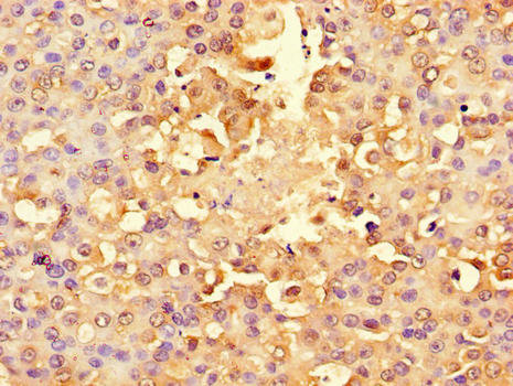 RPS6 / Ribosomal Protein S6 Antibody - Immunohistochemistry of paraffin-embedded human breast cancer using RPS6 Antibody at dilution of 1:100