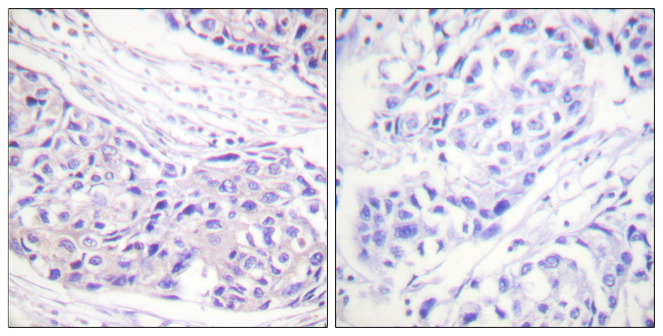 RPS6KA1 / RSK1 Antibody - Immunohistochemistry analysis of paraffin-embedded human breast carcinoma tissue, using p90 RSK Antibody. The picture on the right is blocked with the synthesized peptide.