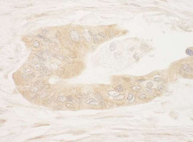 RPS6KA1 / RSK1 Antibody - Detection of Human RSK1 by Immunohistochemistry. Sample: FFPE section of human ovarian carcinoma. Antibody: Affinity purified rabbit anti-RSK1 used at a dilution of 1:250.