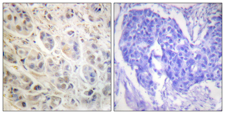 RPS6KA1 / RSK1 Antibody - Immunohistochemistry analysis of paraffin-embedded human breast carcinoma tissue, using p90 RSK Antibody. The picture on the right is blocked with the synthesized peptide.