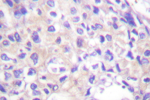 RPS6KA1 / RSK1 Antibody - IHC of p90 RSK (Q374) pAb in paraffin-embedded human breast carcinoma tissue.
