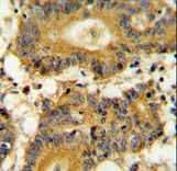 RPS6KA1 / RSK1 Antibody - RPS6KA1 Antibody immunohistochemistry of formalin-fixed and paraffin-embedded human colon carcinoma followed by peroxidase-conjugated secondary antibody and DAB staining.