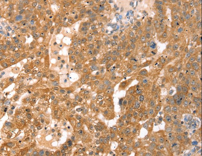 RPS6KA1 / RSK1 Antibody - Immunohistochemistry of paraffin-embedded Human breast cancer using RPS6KA1 Polyclonal Antibody at dilution of 1:30.