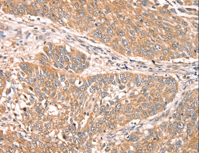 RPS6KA1 / RSK1 Antibody - Immunohistochemistry of paraffin-embedded Human lung cancer using RPS6KA1 Polyclonal Antibody at dilution of 1:30.
