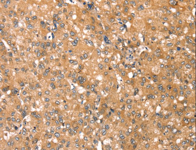 RPS6KA1 / RSK1 Antibody - Immunohistochemistry of paraffin-embedded Human liver cancer using RPS6KA1 Polyclonal Antibody at dilution of 1:45.
