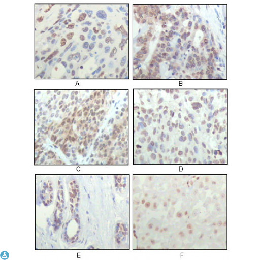 RPS6KA1 / RSK1 Antibody - Immunohistochemistry (IHC) analysis of paraffin-embedded human esophageal squamous cell carcinoma (A), colon adenocarcinoma (B), liver carcinoma (C), skin carcinoma (D), breast ductal tumor (E) and brain tumor (F), showing nuclear localization with DAB staining.