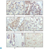 RPS6KA1 / RSK1 Antibody - Immunohistochemistry (IHC) analysis of paraffin-embedded human esophageal squamous cell carcinoma (A), colon adenocarcinoma (B), liver carcinoma (C), skin carcinoma (D), breast ductal tumor (E) and brain tumor (F), showing nuclear localization with DAB staining.