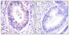 RPS6KA1 / RSK1 Antibody - Peptide - + Immunohistochemistry analysis of paraffin-embedded human colon carcinoma tissue using p90 RSK (Ab-573) antibody.