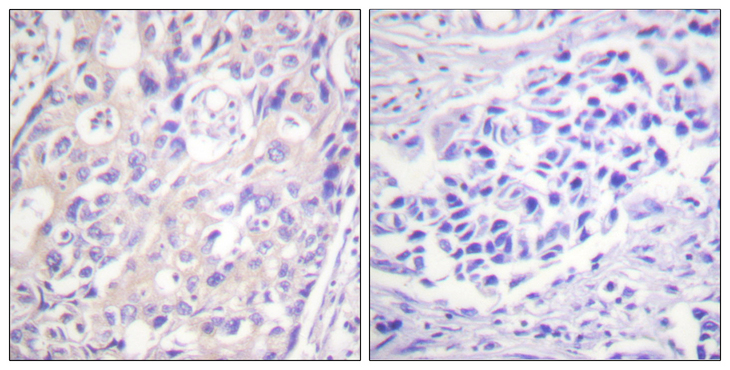 RPS6KA1 / RSK1 Antibody - Immunohistochemistry analysis of paraffin-embedded human breast carcinoma, using p90 RSK (Phospho-Thr359+Ser363) Antibody. The picture on the right is blocked with the phospho peptide.