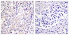 RPS6KA1 / RSK1 Antibody - Immunohistochemistry analysis of paraffin-embedded human breast carcinoma, using p90 RSK (Phospho-Thr359+Ser363) Antibody. The picture on the right is blocked with the phospho peptide.