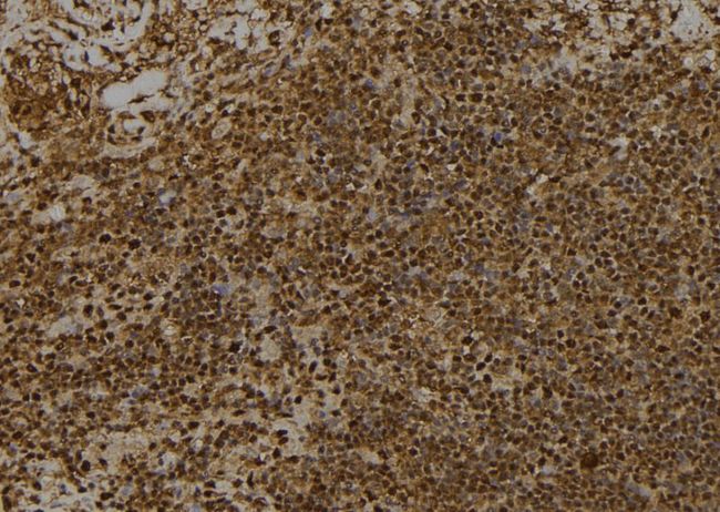 RPS6KA1 / RSK1 Antibody - 1:100 staining human spleen tissue by IHC-P. The sample was formaldehyde fixed and a heat mediated antigen retrieval step in citrate buffer was performed. The sample was then blocked and incubated with the antibody for 1.5 hours at 22°C. An HRP conjugated goat anti-rabbit antibody was used as the secondary.