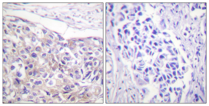 RPS6KA1 / RSK1 Antibody - Immunohistochemistry of paraffin-embedded human breast carcinoma tissue using p90 RSK (Phospho-Thr573) antibody.