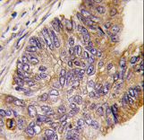 RPS6KA1 / RSK1 Antibody - Formalin-fixed and paraffin-embedded human colon carcinoma tissue reacted with RPS6KA1 Antibody (S732), which was peroxidase-conjugated to the secondary antibody, followed by DAB staining. This data demonstrates the use of this antibody for immunohistochemistry; clinical relevance has not been evaluated.