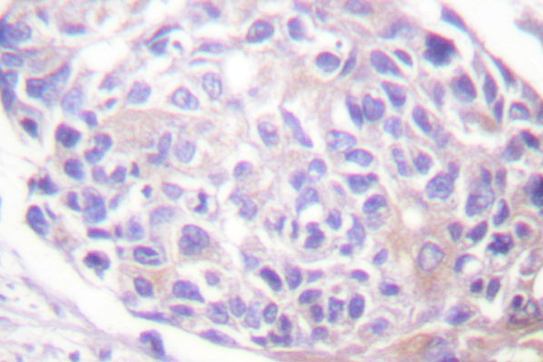 RPS6KA1 / RSK1 Antibody - IHC of p90 RSK (T353) pAb in paraffin-embedded human breast carcinoma tissue.