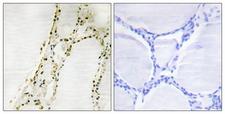 RPS6KA2 / RSK3 Antibody - IHC of paraffin-embedded human thyroid gland tissue, using S6K-alpha2 Antibody. The picture on the right is treated with the synthesized peptide.